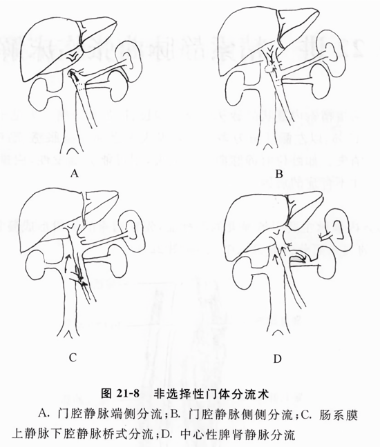 非选择性门体分流术