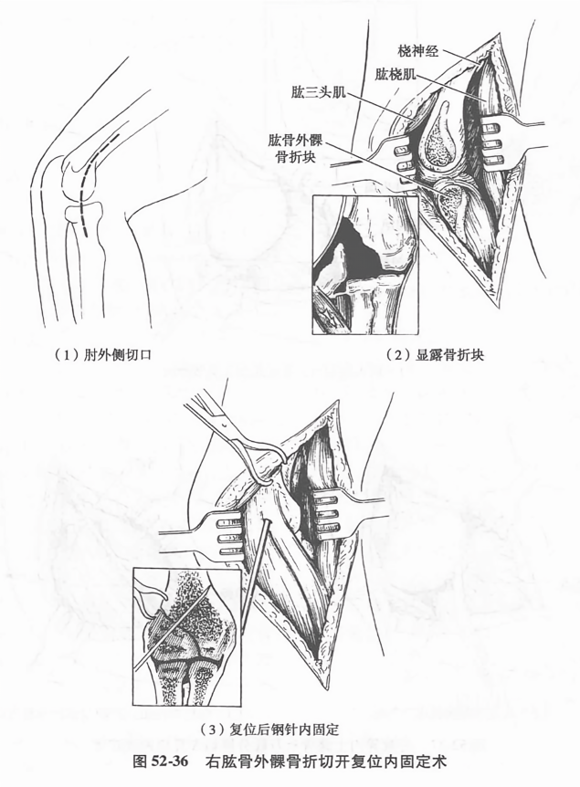 右肱骨外髁骨折切开复位内固定术