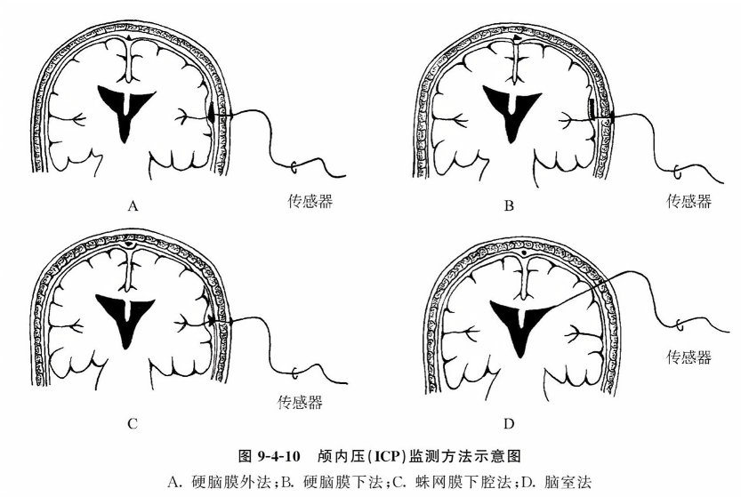 颅内压(icp)监测方法示意图