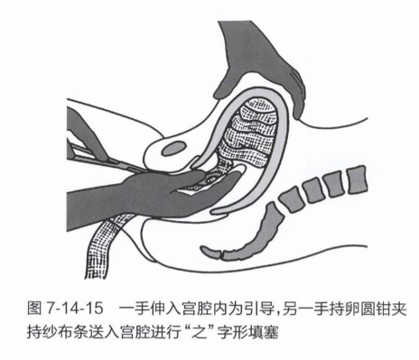 一手伸入宫腔内为引导,另一手持卵圆钳夹持纱布条送入宫腔进行“之”字形填塞