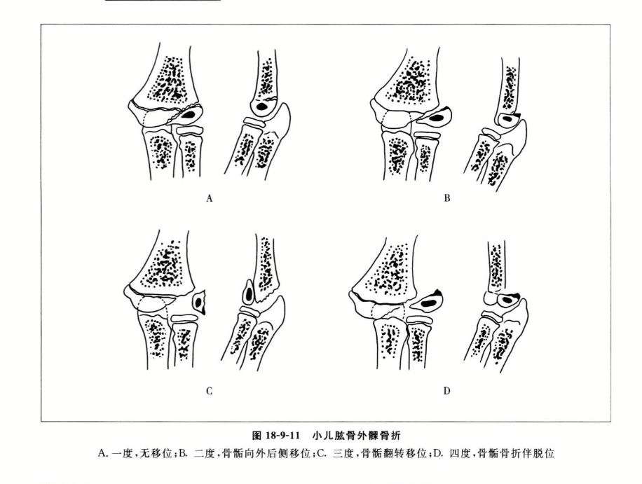 小儿肱骨外髁骨折
