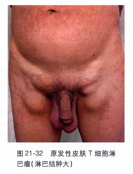 原发性皮肤t细胞淋巴瘤(淋巴结肿大)