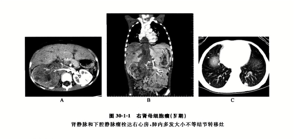 右肾母细胞瘤(Ⅳ期)