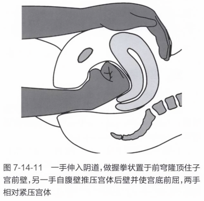 一手伸入阴道,做握拳状置于前穹隆顶住子宫前壁,另一手自腹壁推压宫体后壁并使宫底前屈,两手相对紧压宫体
