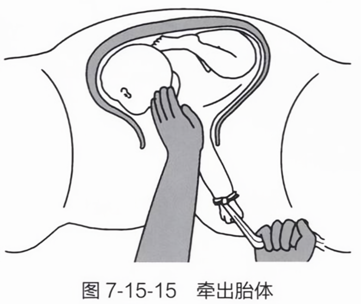 牵出胎体