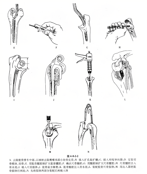 a.去除肱骨滑车中部,以球锉去除鹰嘴项部小块骨皮质；b.插入扩孔钻扩髓;c.插入对线导向器;d.安装
