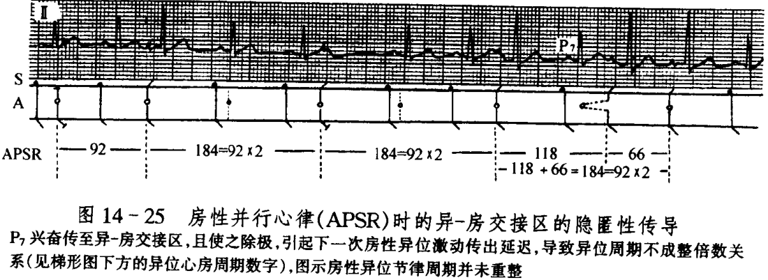 图14-25 房性并行心律(apsr)时的异-房交接区的隐匿性传导