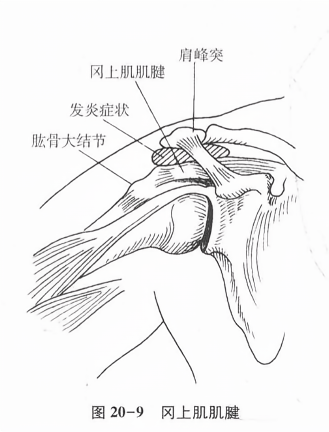 冈上肌肌腱