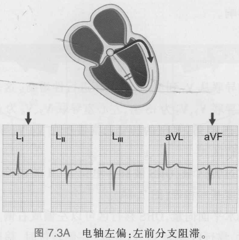 图7.3a 电轴左偏:左前分支阻滞。