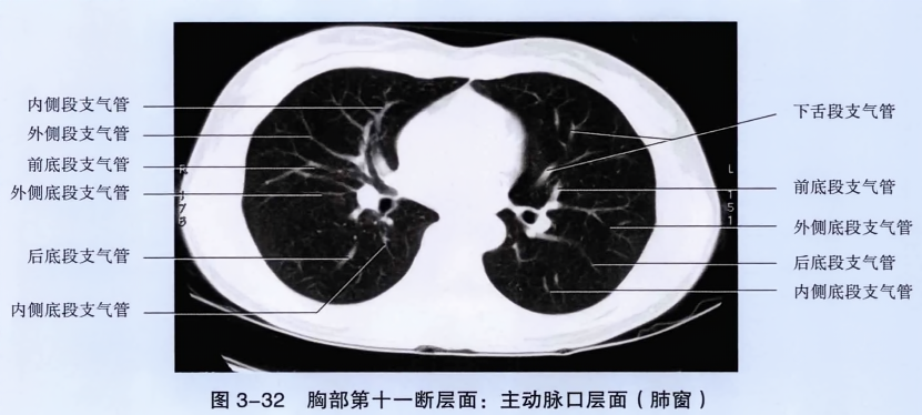 胸部第十一断层面主动脉口层面(肺窗)