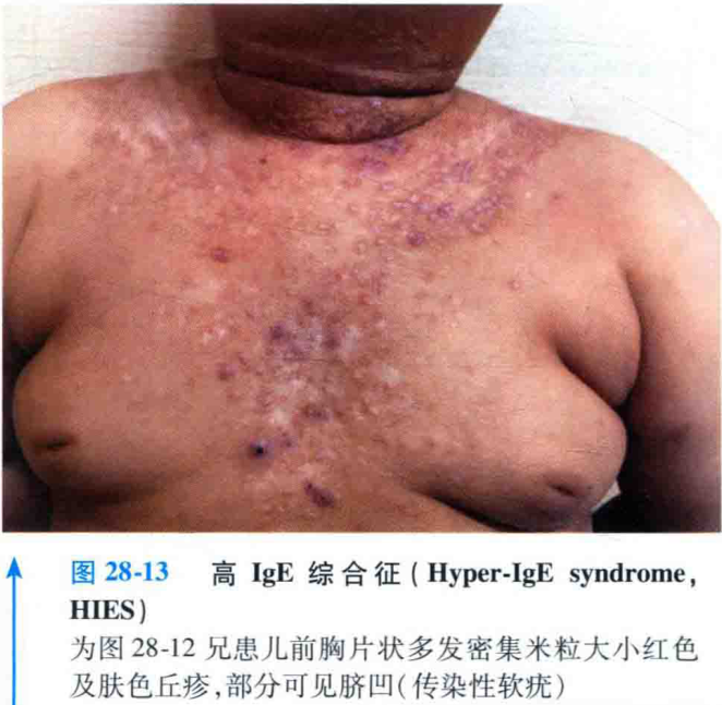 图28-13 hies) 高ige综合征(hyper-ige syndrome, 为图28-12兄患