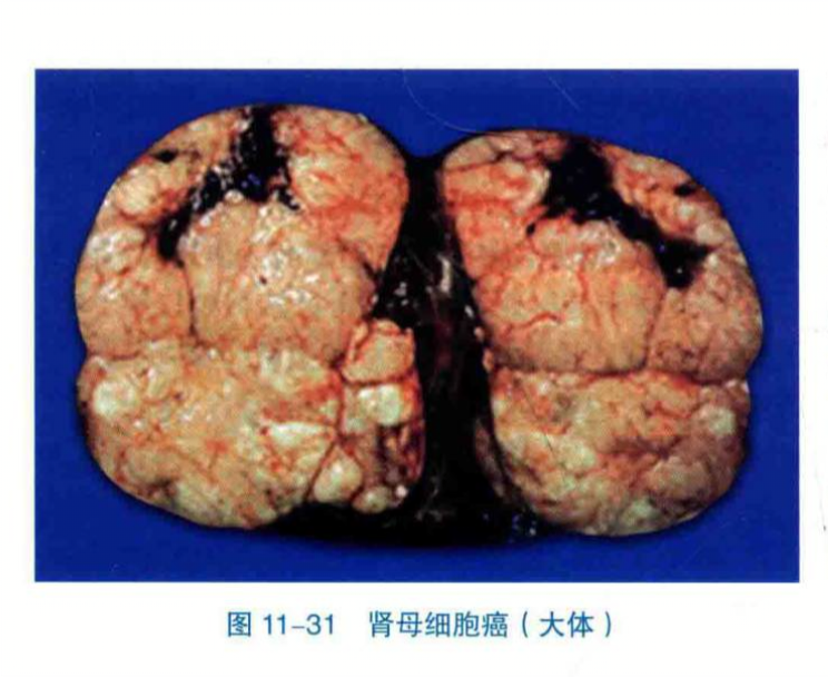 肾母细胞癌(大体)