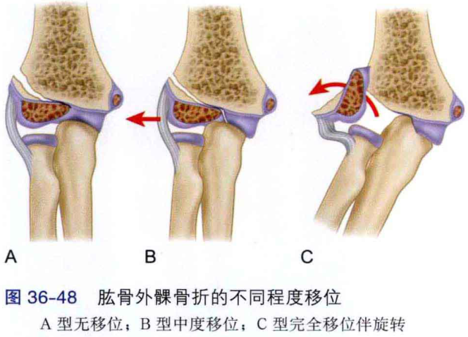 图36-48 肱骨外髁骨折的不同程度移位 a型无移位;b型中度移位;c型完全移位伴旋转