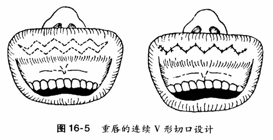 重唇的连续v形切口设计