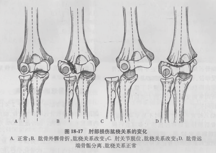 肘部损伤肱桡关系的变化