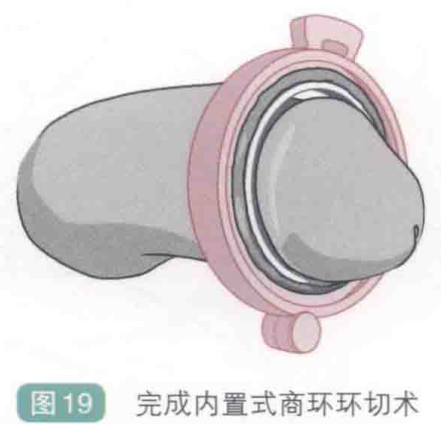 图19 完成内置式商环环切术