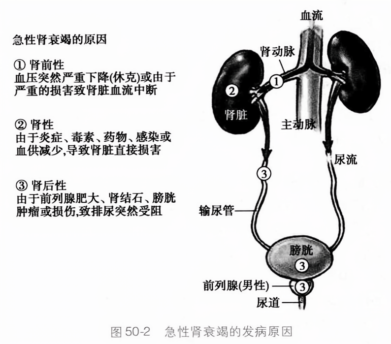 急性肾衰竭的发病原因