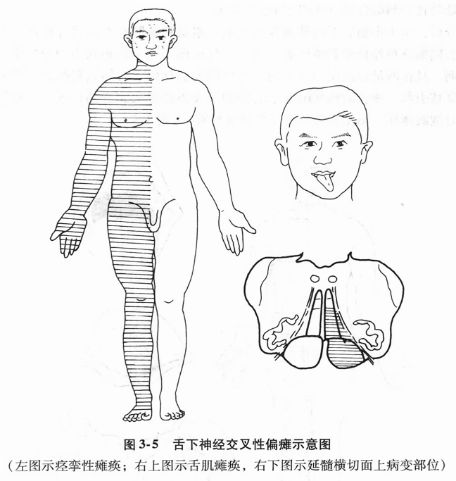 舌下神经交叉性偏瘫示意图