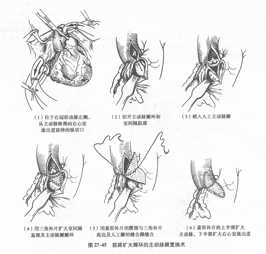 前路扩大瓣环的主动脉瓣置换术
