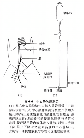 中心静脉压测定