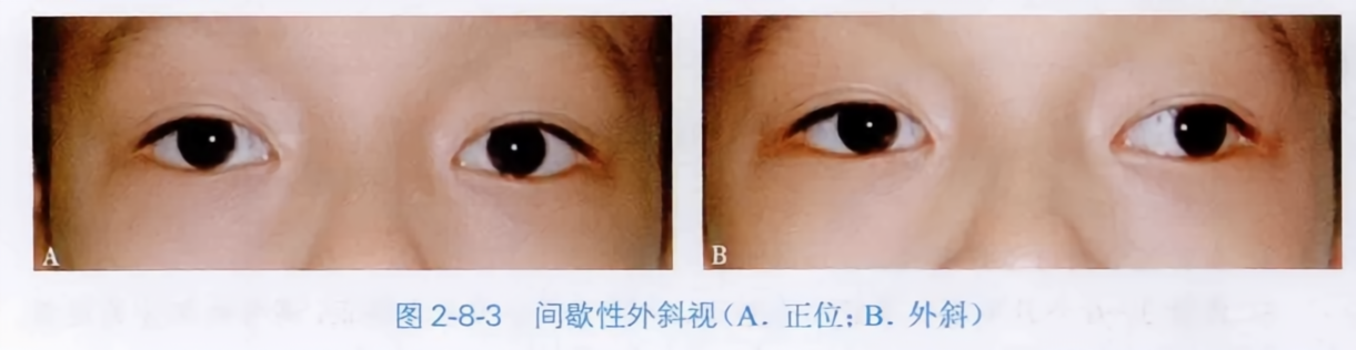 间歇性外斜视(a.正位;b.外斜)
