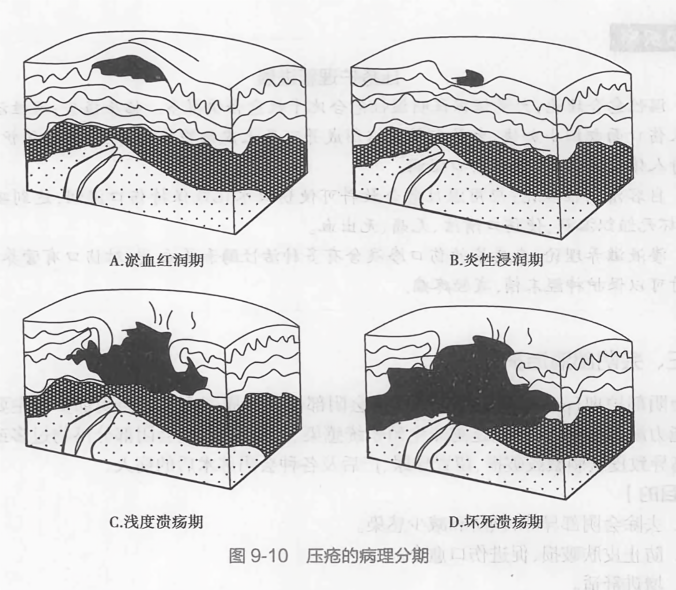 压疮的病理分期