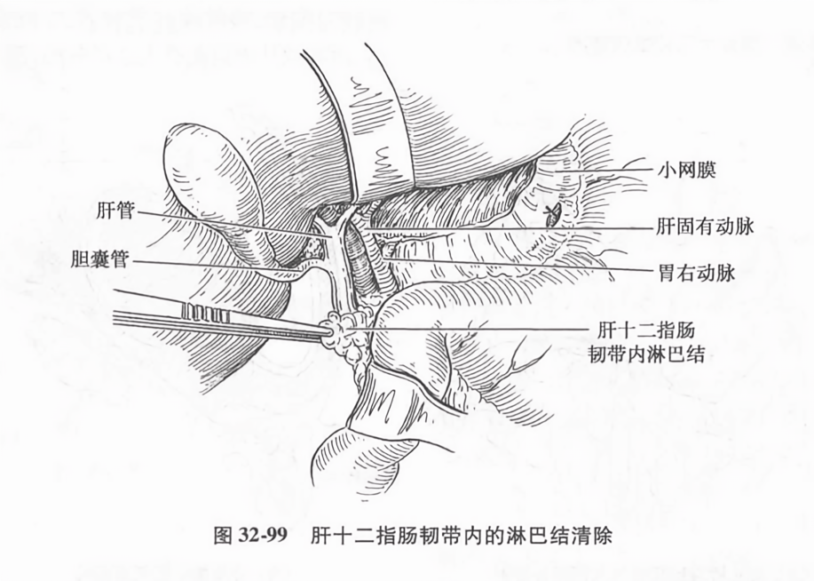 肝十二指肠韧带内的淋巴结清除