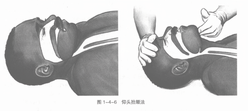 仰头抬颏法