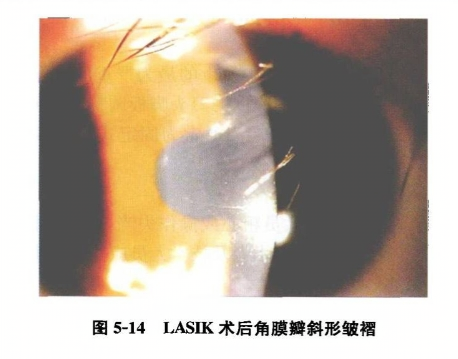 lasik术后角膜瓣斜形皱褶