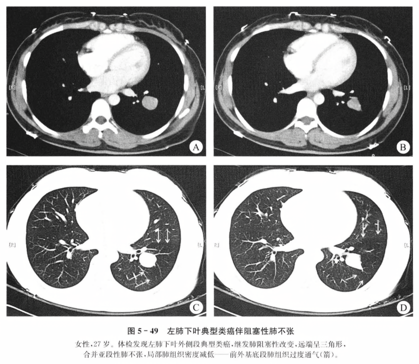 左肺下叶典型类癌伴阻塞性肺不张