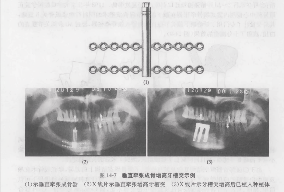 垂直牵张成骨增高牙槽突示例