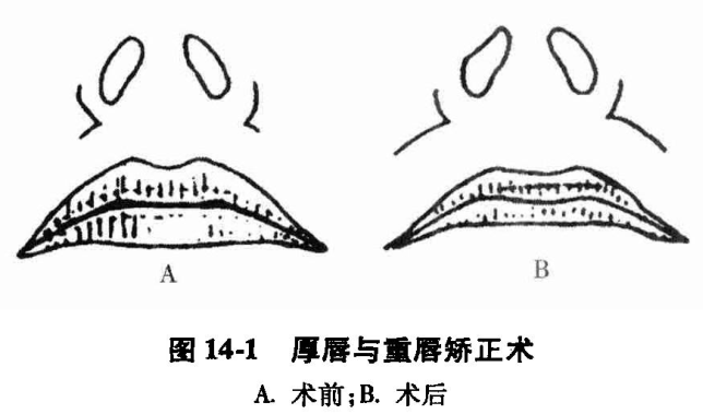 图14-1 厚唇与重唇矫正术 a.术前;b.术后