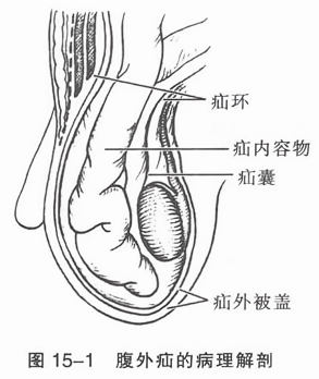 腹外疝的病理解剖