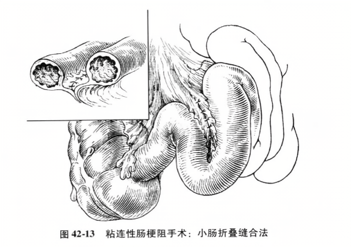 粘连性肠梗阻手术小肠折叠缝合法