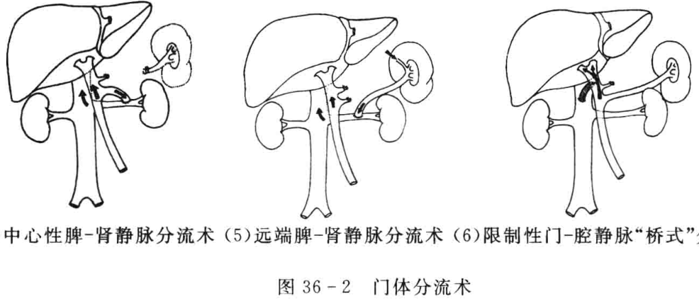 图36-2 门体分流术