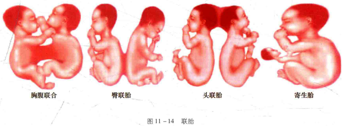 图11-14 联胎