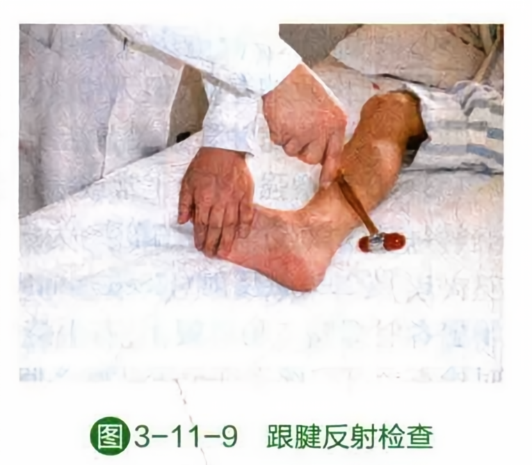 跟腱反射检查