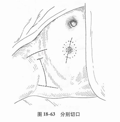 分别切口