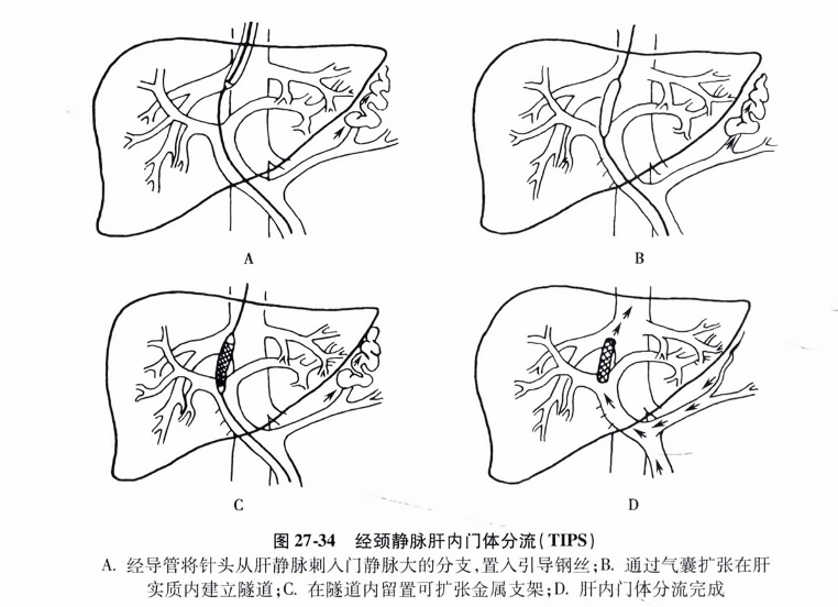 经颈静脉肝内门体分流(tips)