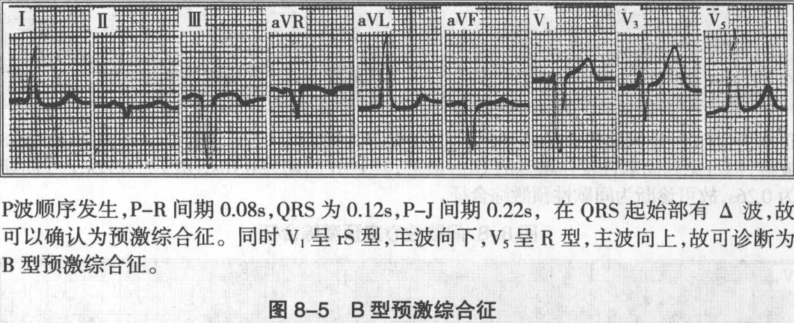图8-5 b型预激综合征