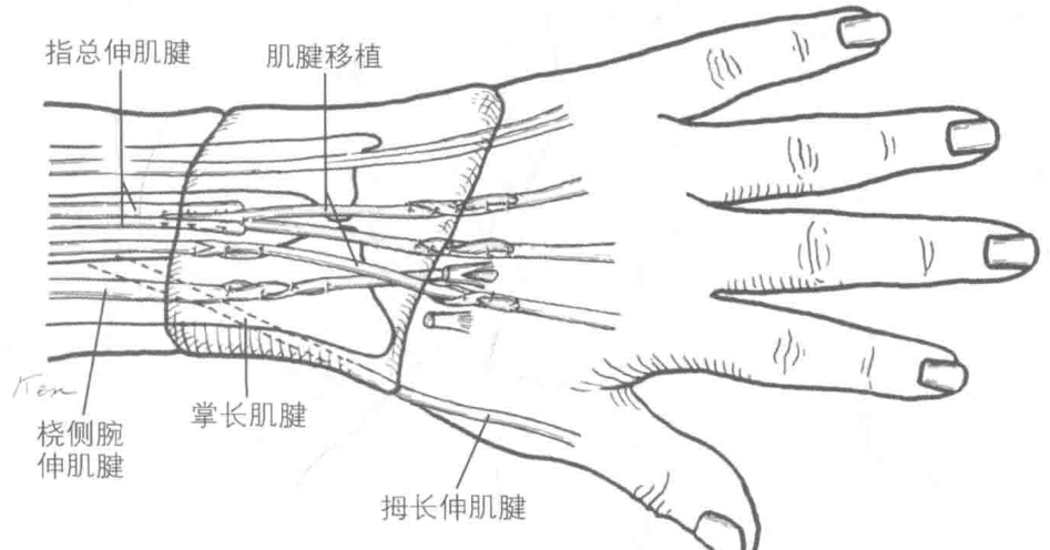 拇长伸肌腱