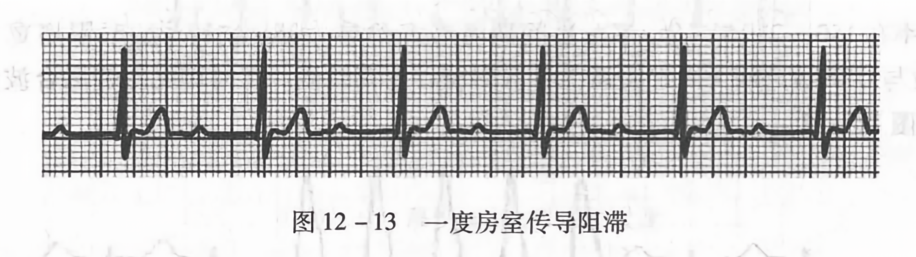一度房室传导阻滞