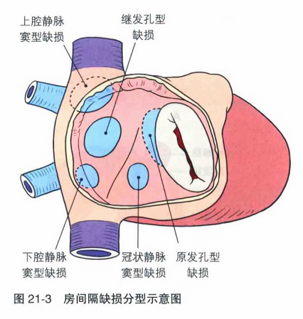 房间隔缺损分型示意图