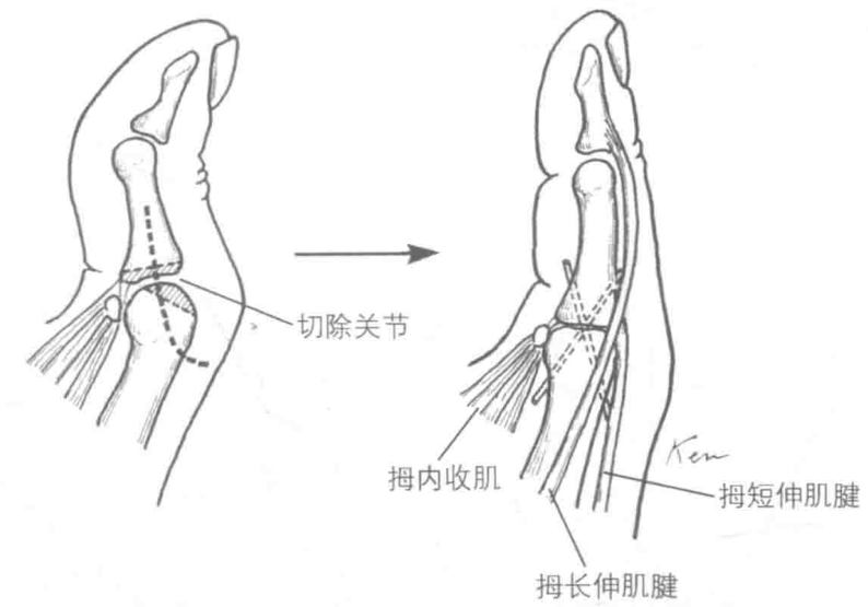 拇长伸肌腱