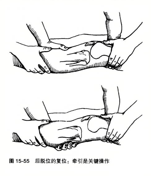 后脱位的复位-牵引是关键操作