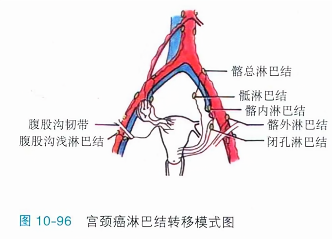 宫颈癌淋巴结转移模式图