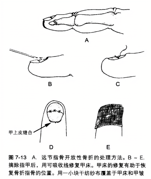 a.远节指骨开放性骨折的处理方法。