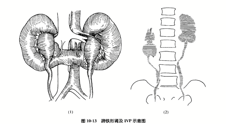 蹄铁形肾及ivp示意图