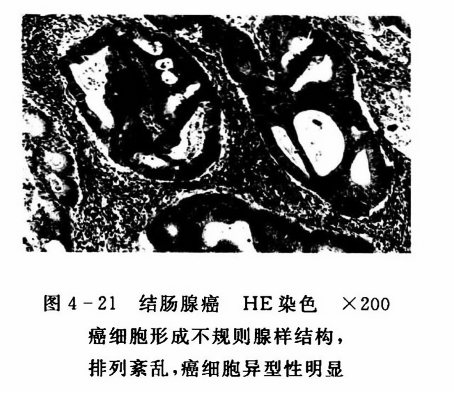 结肠腺癌he染色x200