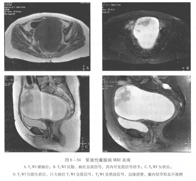 浆液性囊腺癌mr表现